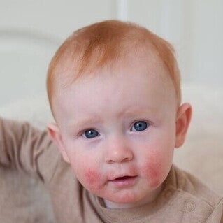 Um bebê com erupções cutâneas vermelhas no rosto, que pode ser um dos sintomas de APLV (Alergia à Proteína do Leite de Vaca) em bebê.