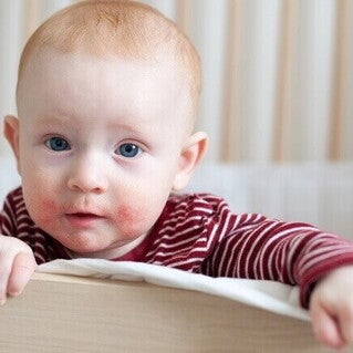 Close-up de um bebê no berço, mostrando a pele do rosto vermelha e com erupções cutâneas, um sintoma comum da APLV em bebê.