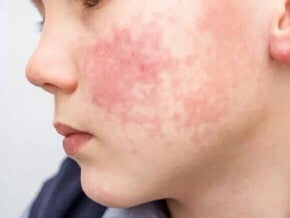 Alergia alimentar infantil Foto de uma criança com alergia alimentar. Em destaque, está a bochecha do garoto com marcas bem vermelhas e irritação de pele..