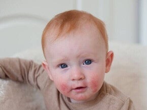 Um bebê com erupções cutâneas vermelhas no rosto, que pode ser um dos sintomas de APLV (Alergia à Proteína do Leite de Vaca) em bebê.