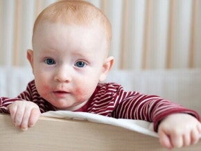 Close-up de um bebê no berço, mostrando a pele do rosto vermelha e com erupções cutâneas, um sintoma comum da APLV em bebê.