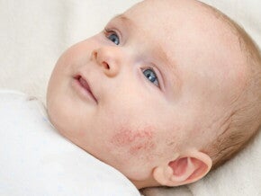 bebê com dermatite na bochecha