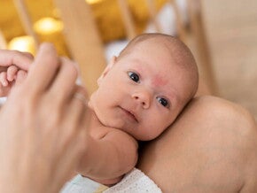 bebê com indício de sarna na testa bebê com indício de sarna na testa