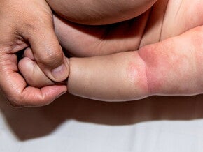 braço de bebê com manchas avermelhadas braço de bebê com manchas avermelhadas