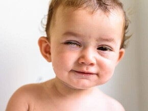 Bebê com um olho aberto e o outro fechado, aparentando uma lesão em um dos olhos. Bebê com um olho aberto e o outro fechado, aparentando uma lesão em um dos olhos.