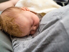 Um bebê com uma área grande de crosta láctea no lado direito da cabeça, deitado no colo de um adulto.