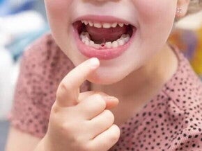 Uma criança com a boca aberta aponta para um dente de leite que caiu.