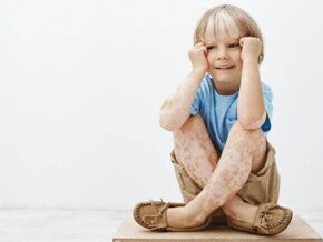 Criança sentada com os braços apoiados nas pernas e encostando as mãos no rosto, com manchas na pele.