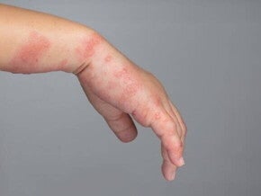 Close-up da mão e pulso de uma criança com erupções cutâneas vermelhas e bolhas, indicando uma condição de pele como a sarna infantil.