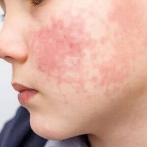 Alergia alimentar infantil Foto de uma criança com alergia alimentar. Em destaque, está a bochecha do garoto com marcas bem vermelhas e irritação de pele..