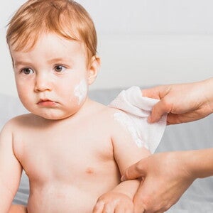 Mulher fazendo compressas e aplicando pomada em bebê com alergia do calor Mulher fazendo compressas e aplicando pomada em bebê com alergia do calor