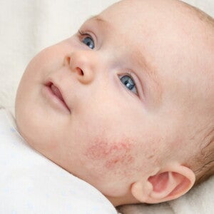 bebê com dermatite na bochecha bebê com dermatite na bochecha