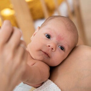 bebê com indício de sarna na testa bebê com indício de sarna na testa