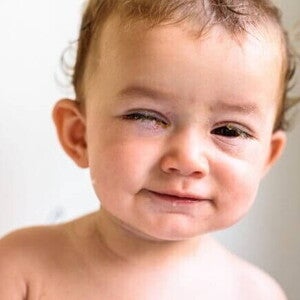 Bebê com um olho aberto e o outro fechado, aparentando uma lesão em um dos olhos. Bebê com um olho aberto e o outro fechado, aparentando uma lesão em um dos olhos.