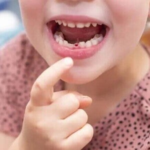 Tchau, dente de leite: quando acontece a troca de dentinhos Uma criança com a boca aberta aponta para um dente de leite que caiu.