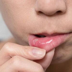 Close-up dos lábios e do queixo de uma pessoa segurando o lábio inferior para expor uma ferida branca e dolorosa, sintoma comum da estomatite infantil.