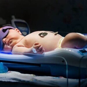 Recém-nascido passando por um procedimento de fototerapia neonatal. Recém-nascido passando por um procedimento de fototerapia neonatal.