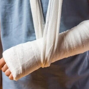 Criança com antebraço enfaixado, uma das mais comuns fraturas em crianças. Criança com antebraço enfaixado, uma das mais comuns fraturas em crianças.