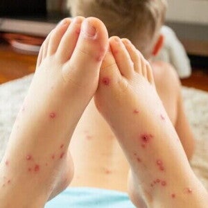 Criança deitada em um tapete com os pés cheios de feridas em destaque Criança deitada em um tapete com os pés cheios de feridas em destaque