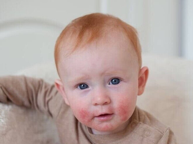 Um bebê com erupções cutâneas vermelhas no rosto, que pode ser um dos sintomas de APLV (Alergia à Proteína do Leite de Vaca) em bebê.