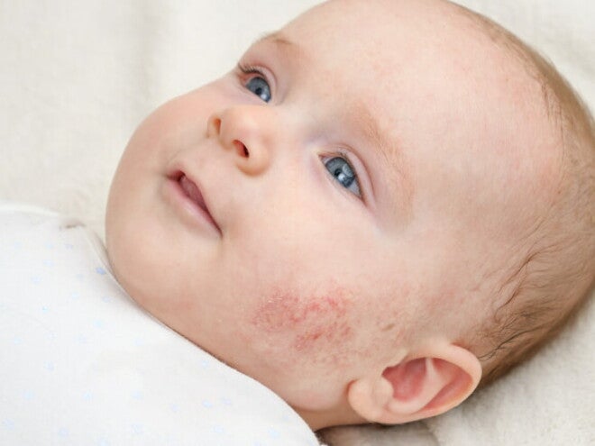 bebê com dermatite na bochecha bebê com dermatite na bochecha