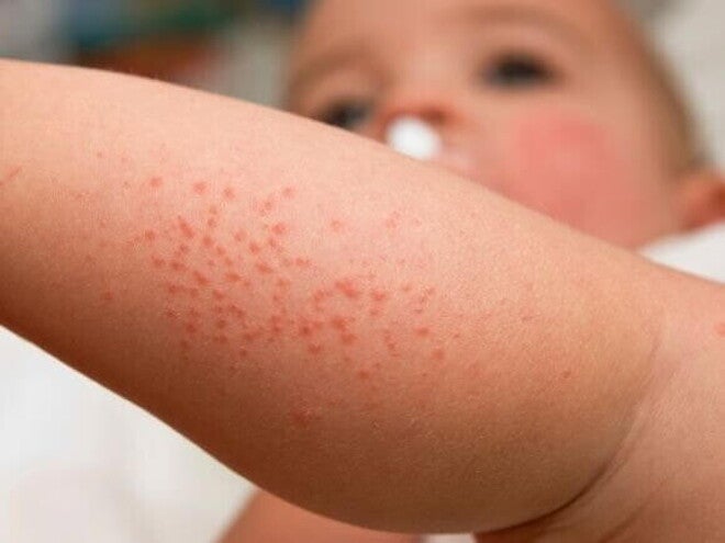 Close-up do braço de um bebê com pequenas manchas vermelhas elevadas, mostrando a aparência típica da brotoeja em bebê ou miliária, uma irritação comum da pele.