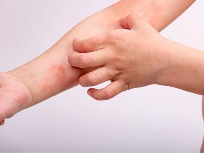 Braço de criança com manchas vermelhas e lesões na pele, sendo coçado. Essa é uma manifestação comum de dermatite APLV ou outra alergia alimentar.