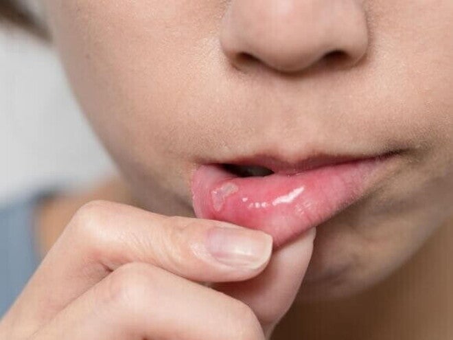 Close-up dos lábios e do queixo de uma pessoa segurando o lábio inferior para expor uma ferida branca e dolorosa, sintoma comum da estomatite infantil.