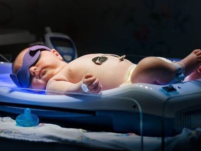 Recém-nascido passando por um procedimento de fototerapia neonatal. Recém-nascido passando por um procedimento de fototerapia neonatal.