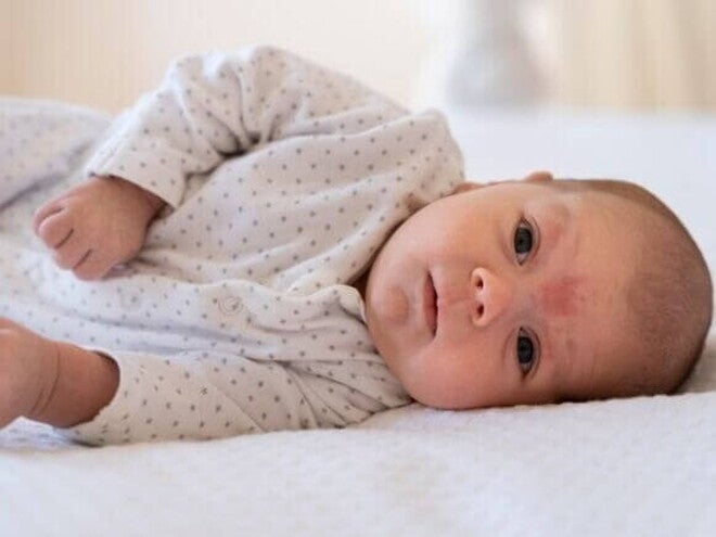 Um bebê deitado com uma mancha na testa que indica uma infecção fúngica Um bebê deitado com uma mancha na testa que indica uma infecção fúngica