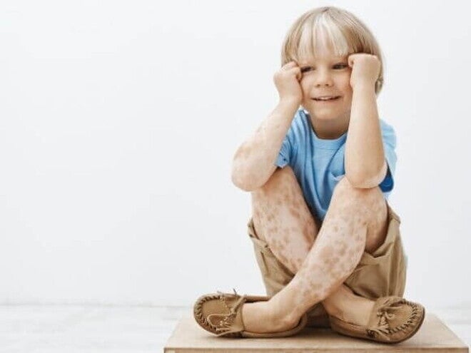 Criança sentada com os braços apoiados nas pernas e encostando as mãos no rosto, com manchas na pele. Criança sentada com os braços apoiados nas pernas e encostando as mãos no rosto, com manchas na pele.