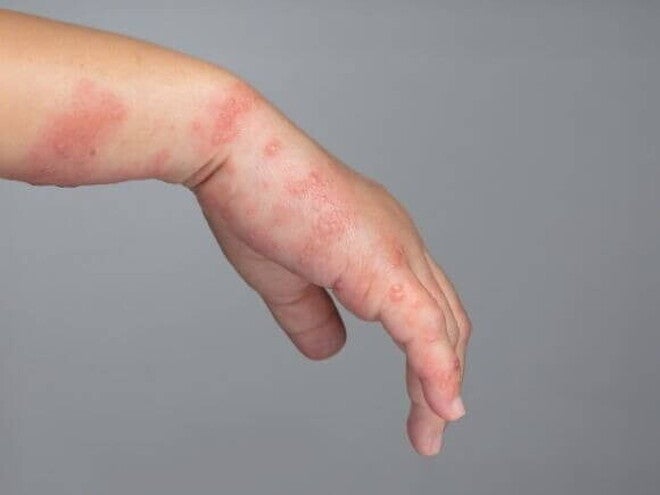 Close-up da mão e pulso de uma criança com erupções cutâneas vermelhas e bolhas, indicando uma condição de pele como a sarna infantil.