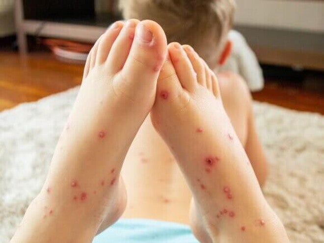 Criança deitada em um tapete com os pés cheios de feridas em destaque Criança deitada em um tapete com os pés cheios de feridas em destaque