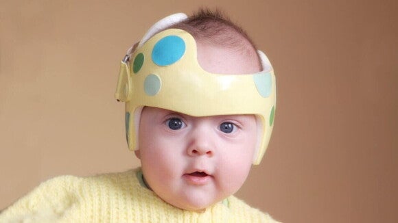 Um bebê utilizando uma órtese craniana, popularmente conhecida como "capacete" Um bebê utilizando uma órtese craniana, popularmente conhecida como "capacete"