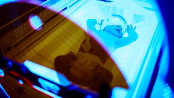 bebê deitado sob luz azul intensa de fototerapia, usando máscara de proteção ocular branca.