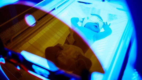 Recém-nascido passando por um procedimento de fototerapia neonatal. Recém-nascido passando por um procedimento de fototerapia neonatal.