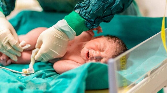 Um bebê recém-nascido deitado e com a boca aberta, enquanto um profissional da saúde retira o seu cordão umbilical Um bebê recém-nascido deitado e com a boca aberta, enquanto um profissional da saúde retira o seu cordão umbilical