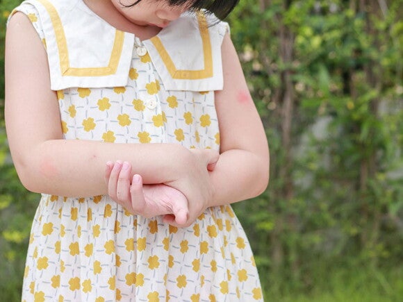 A roséola é contagiosa? Imagem de menina em um vestido amarelo e branco com roséola infantil (erupção cutânea vermelha que aparece após a queda da temperatura) no braço esquerdo.