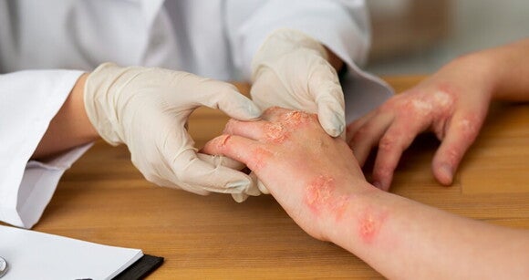 médico examinando mãos de paciente com erupções cutâneas médico examinando mãos de paciente com erupções cutâneas