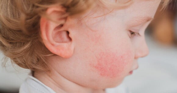 Perfil de um bebê com lesão lesão avermelhada na bochecha Perfil de um bebê com lesão lesão avermelhada na bochecha