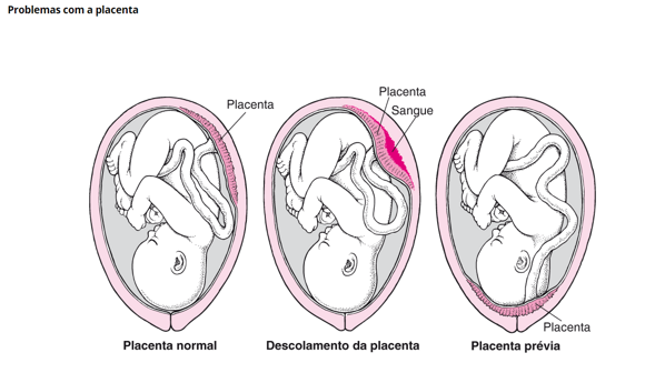 problemas com a placenta problemas com a placenta