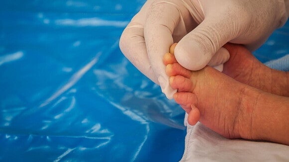 Uma mão enluvada de um profissional de saúde examinando os pés de um recém-nascido, possivelmente verificando por polidactilia (dedos extras), uma anomalia física que pode estar presente em casos de síndrome de Patau.