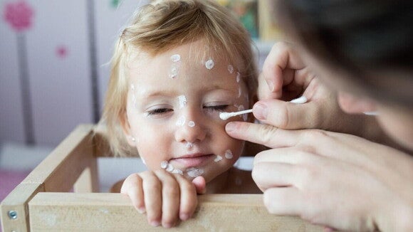 Uma mãe ou cuidadora aplicando um creme ou loção calmante nas bolhas do rosto de uma criança pequena com catapora, ilustrando a forma de tratar e aliviar os sintomas de catapora em criança. Uma mãe ou cuidadora aplicando um creme ou loção calmante nas bolhas do rosto de uma criança pequena com catapora, ilustrando a forma de tratar e aliviar os sintomas de catapora em criança.