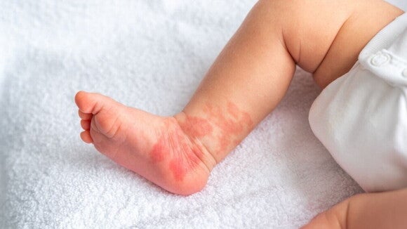O pé e a parte inferior da perna de um bebê com uma erupção cutânea vermelha. O pé e a parte inferior da perna de um bebê com uma erupção cutânea vermelha.